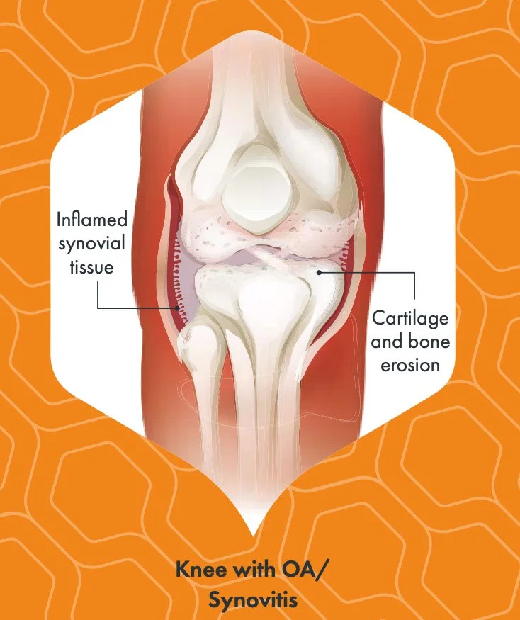 Sore Knees? Here’s a New Option for Knee Osteoarthritis Relief