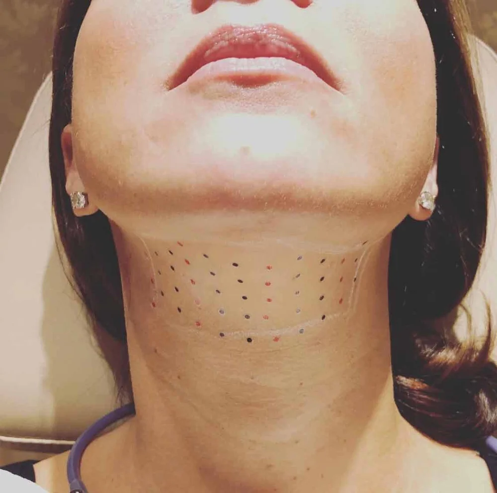 Double Chin Treatment London Ontario | Bold & Co. Medical Aesthetics