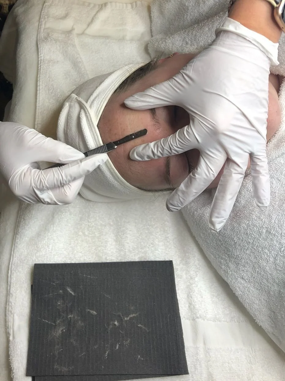 Microneedling, Microdermabrasion & Dermaplaning London Ontario Bare