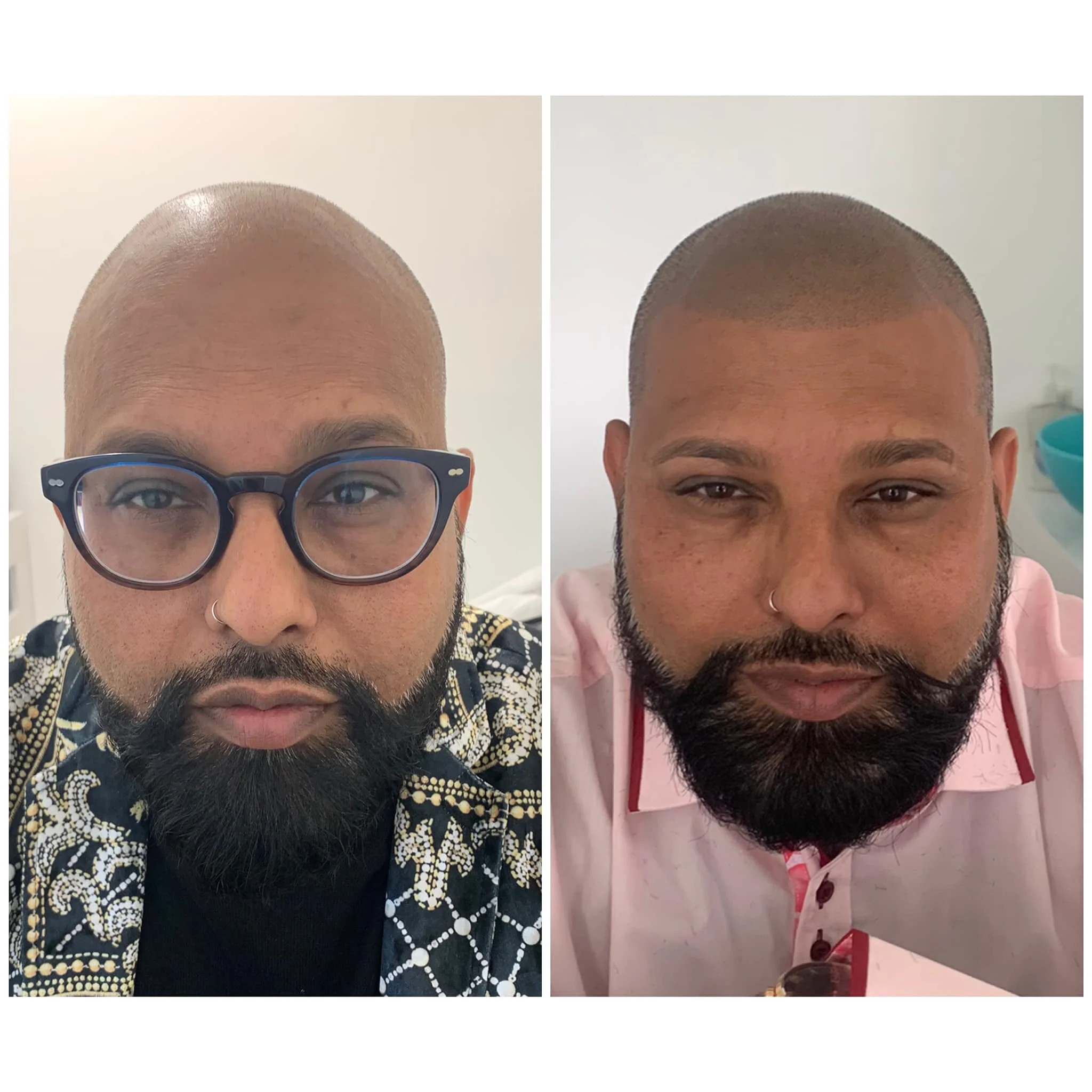 smp scalp pigmentation micropigmentation head tattoo hair loss