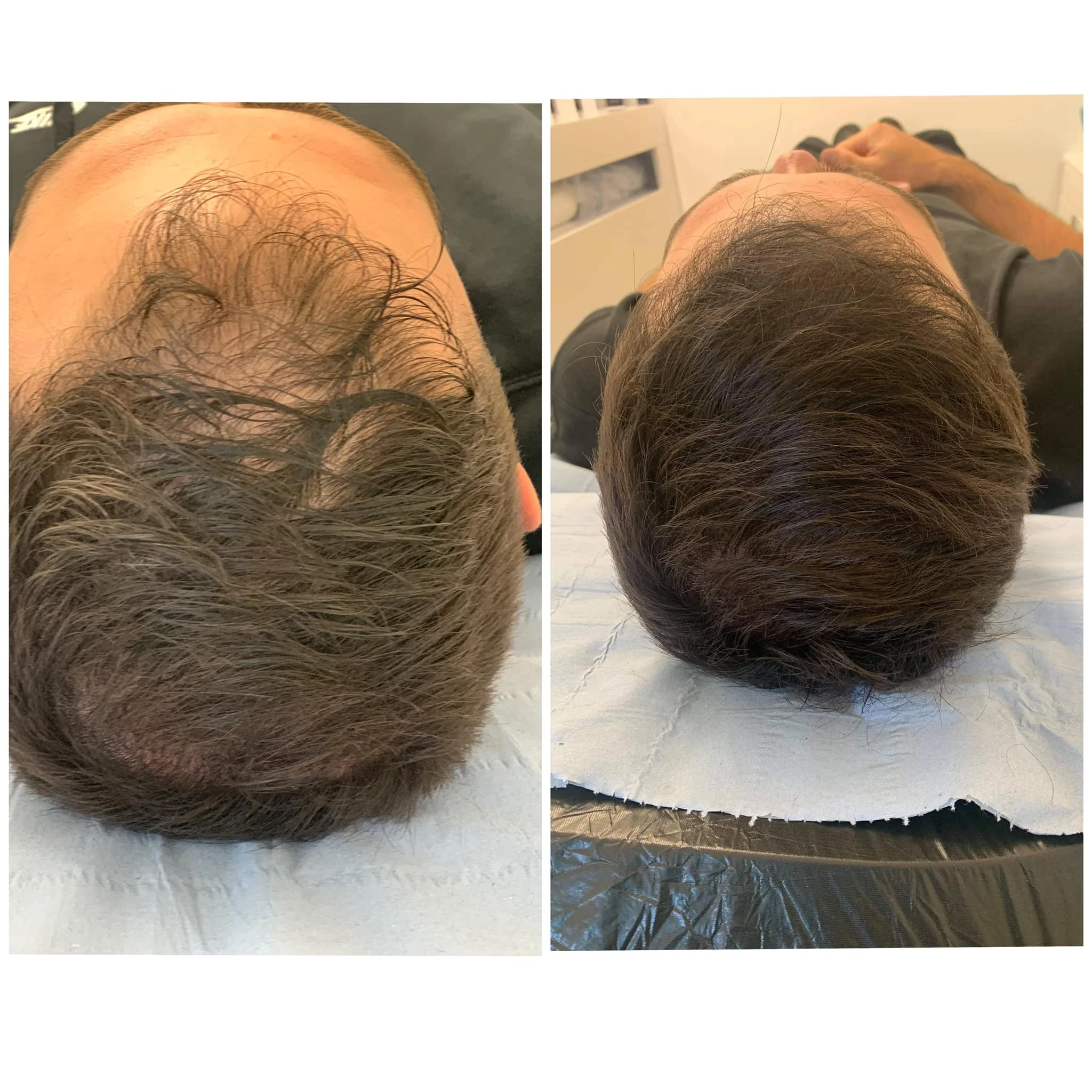 smp scalp pigmentation micropigmentation head tattoo hair loss