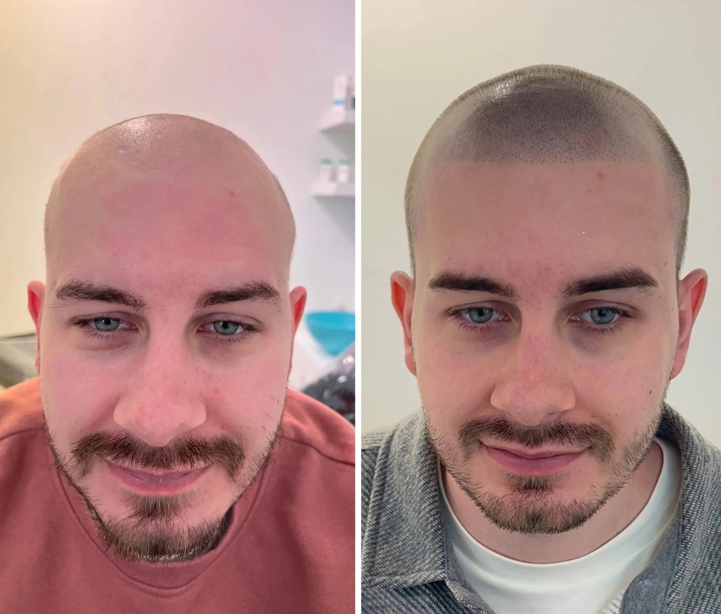 smp scalp pigmentation micropigmentation head tattoo hair loss