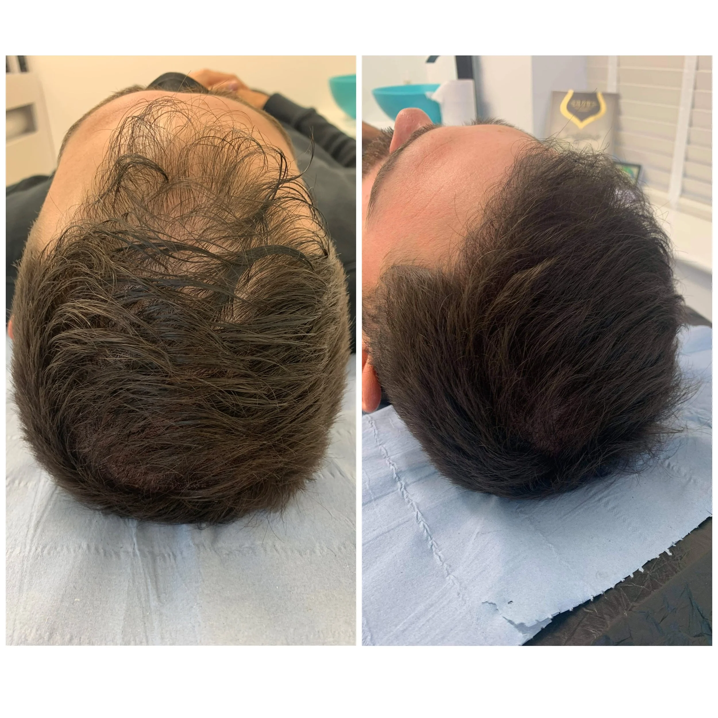 smp scalp pigmentation micropigmentation head tattoo hair loss