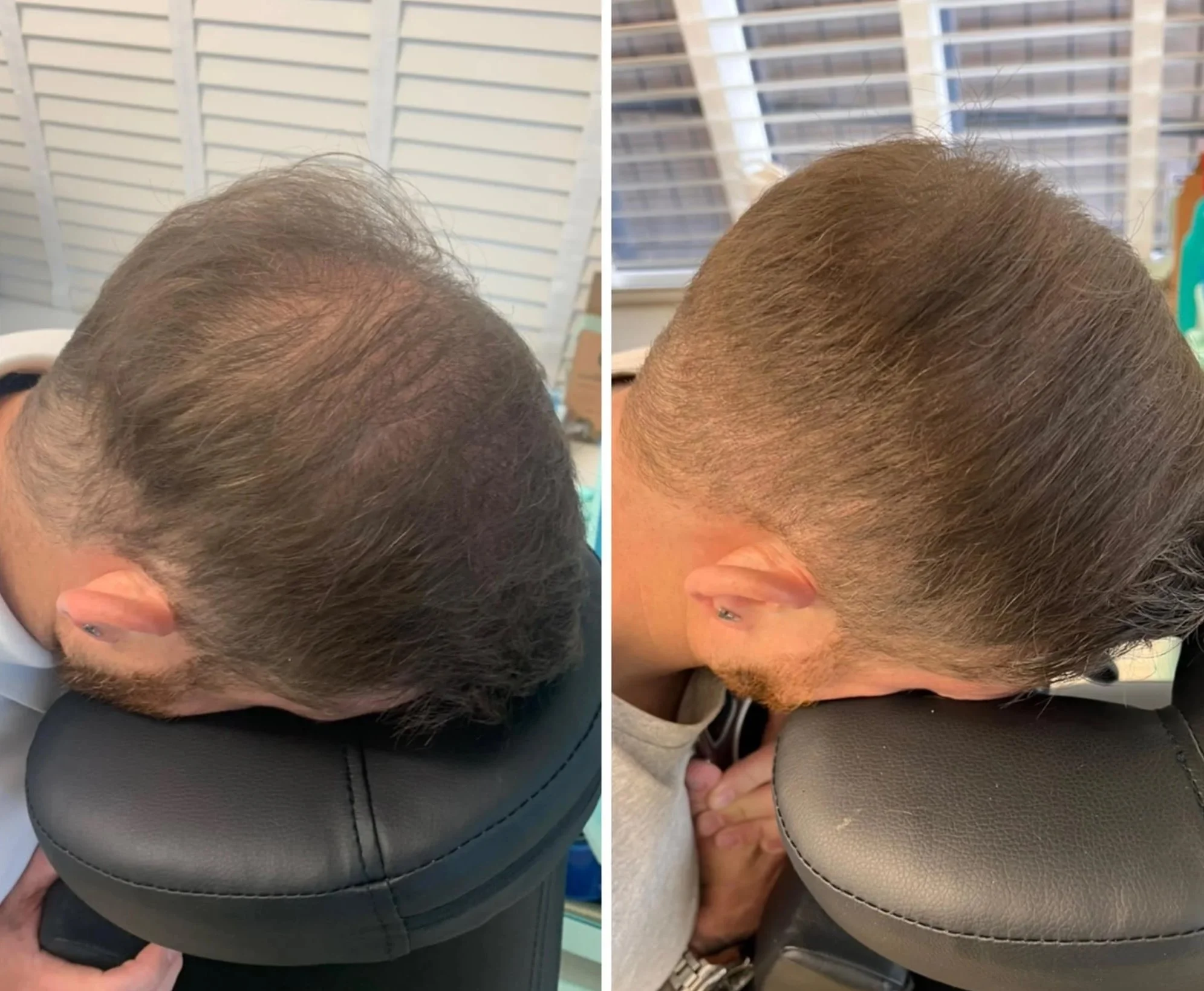 smp scalp pigmentation micropigmentation head tattoo hair loss