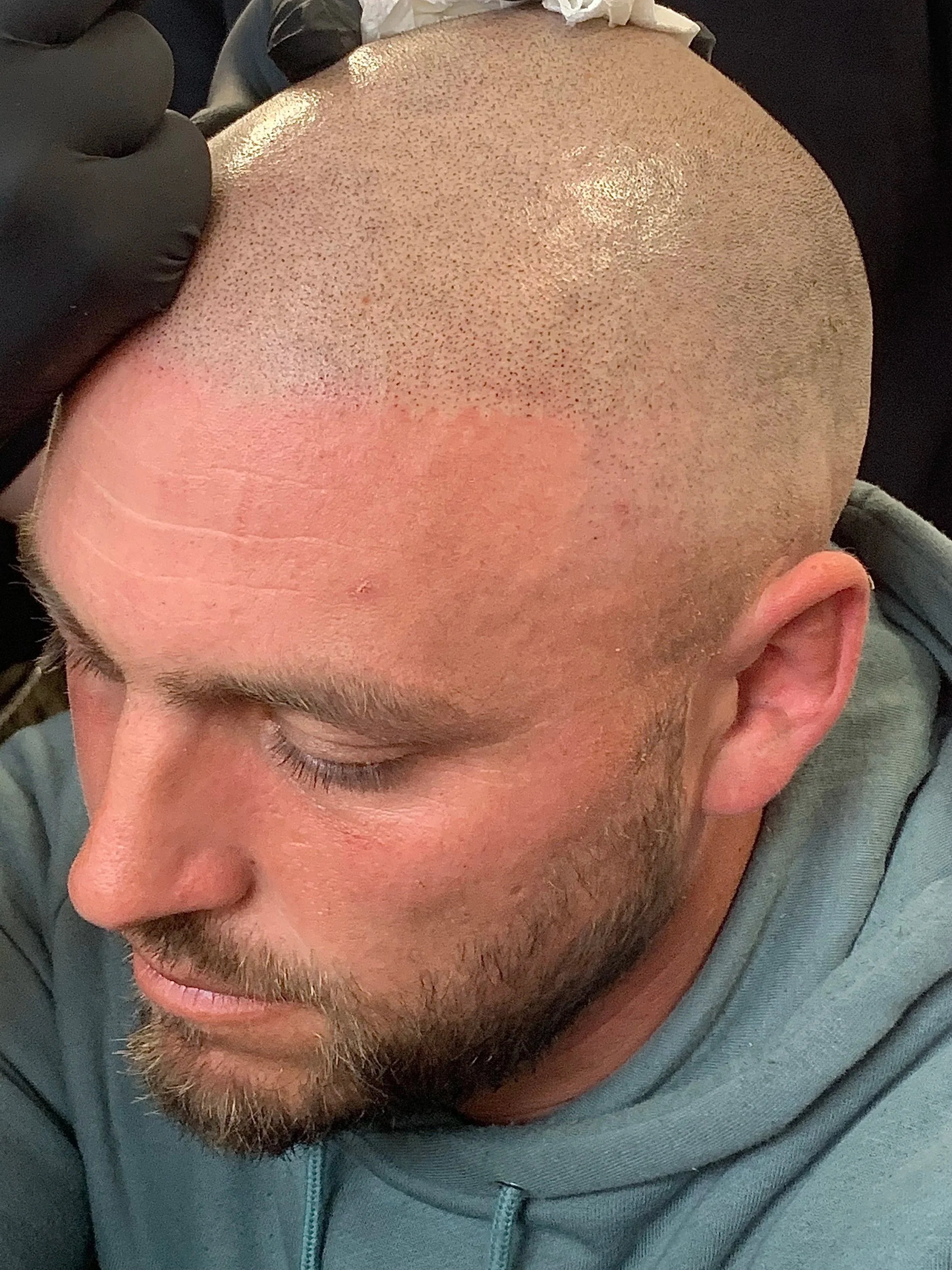 A man with a shaved head and beard receives a scalp micropigmentation treatment, with a technician applying paint or ink to create a stippled hair follicle effect.
