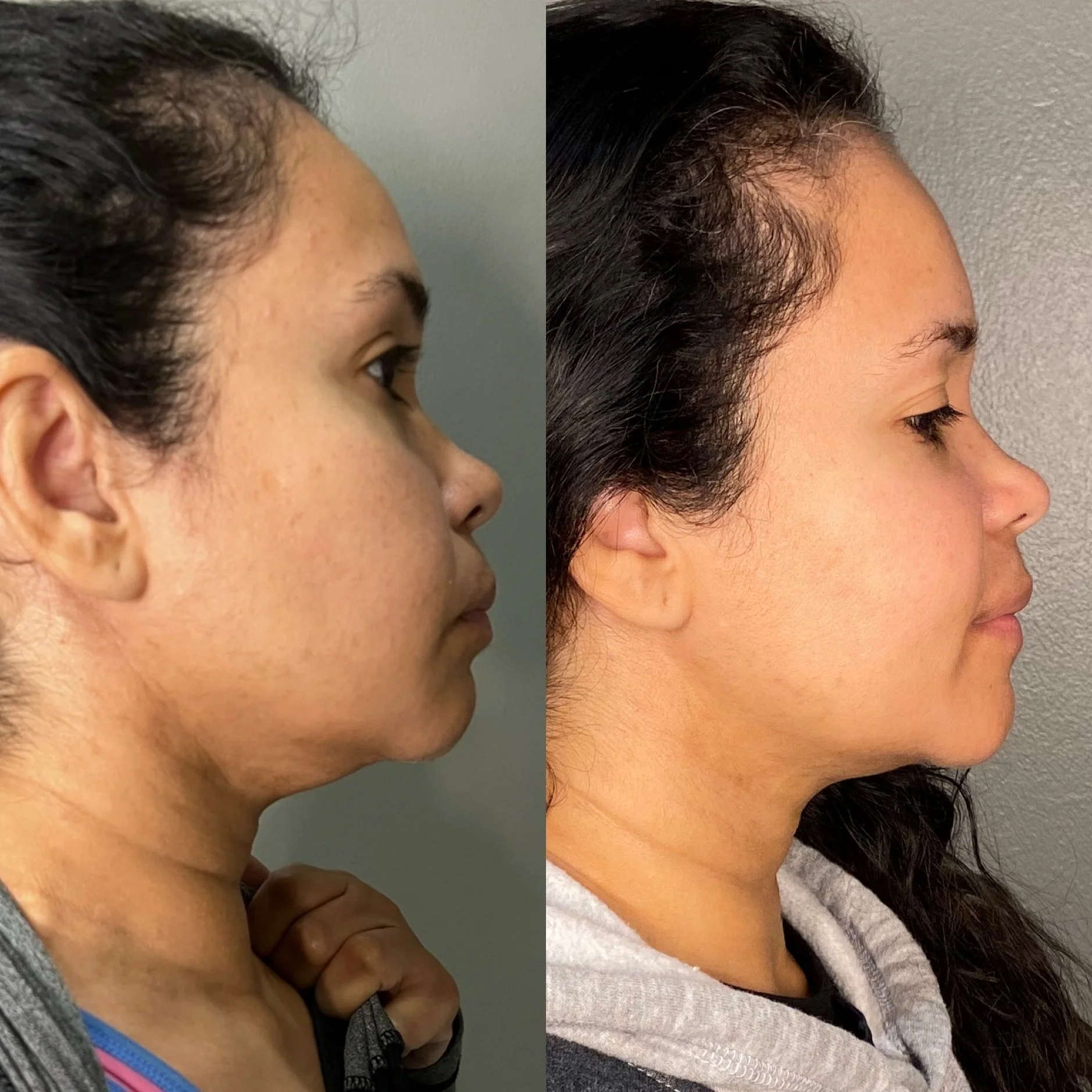 Microneedling Before and After, Houston, TX, at Lush RX in Bellaire
