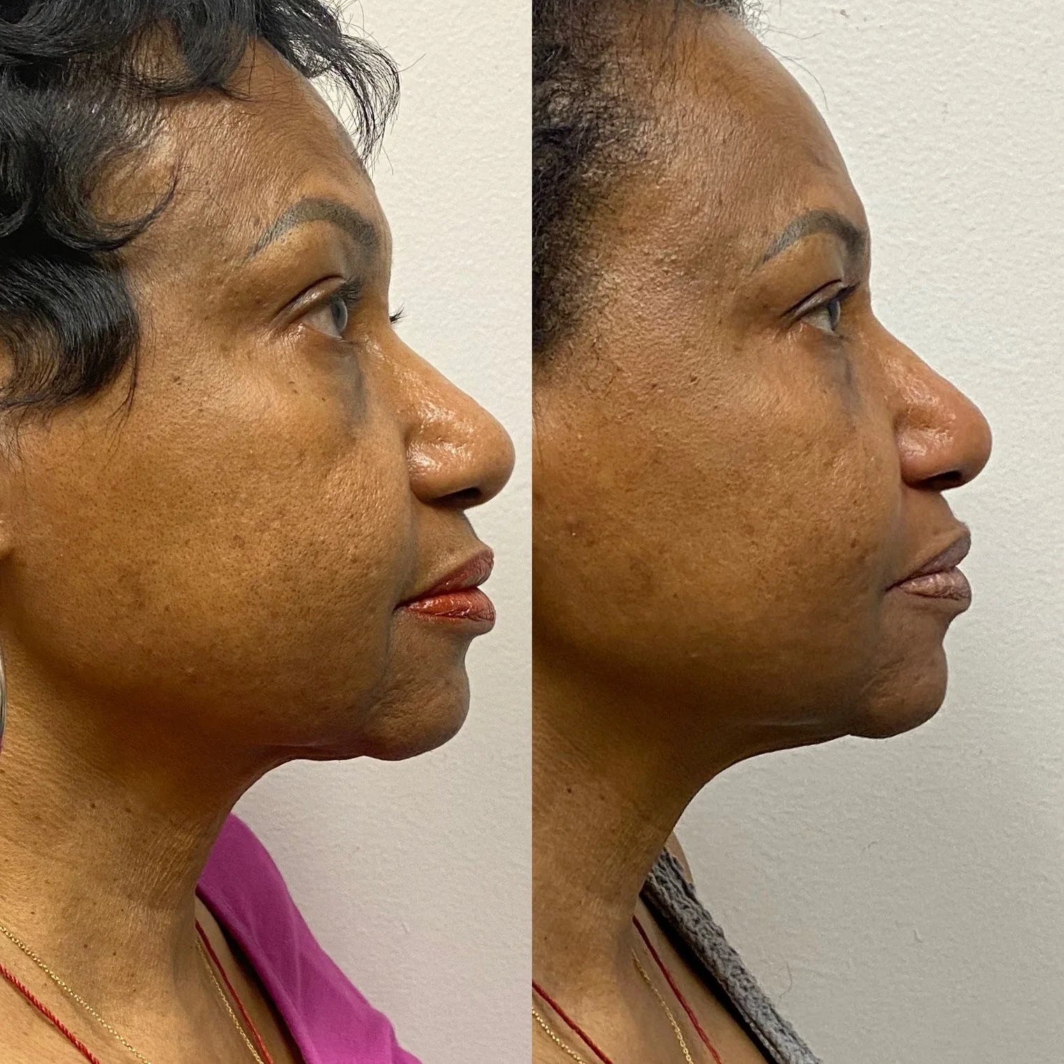 Laser Treatment Before and After in Houston, TX, at LushRX.