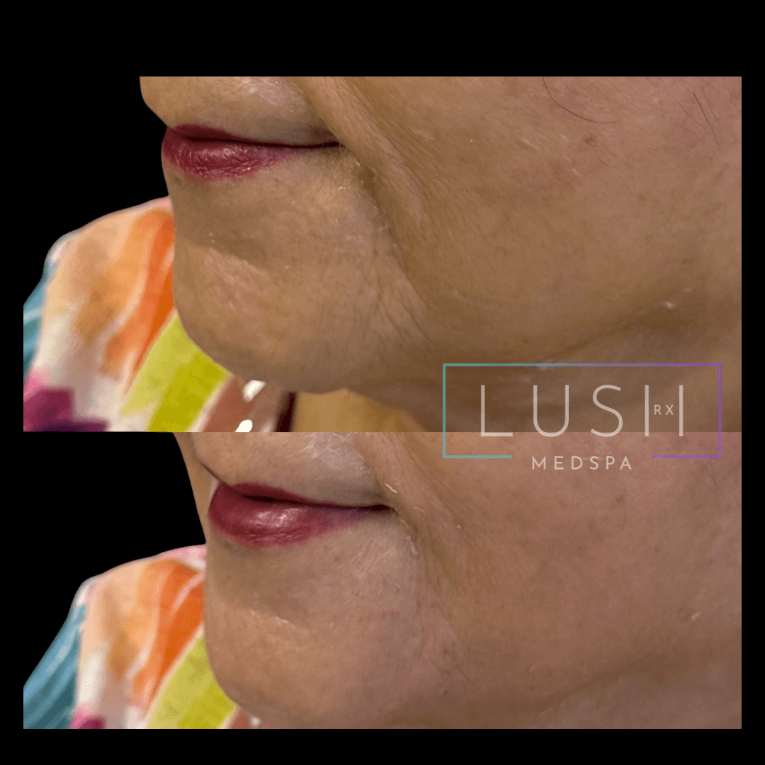 Compressed_before-and-after-smile-lines-treatment-houston-tx_LushRX.png