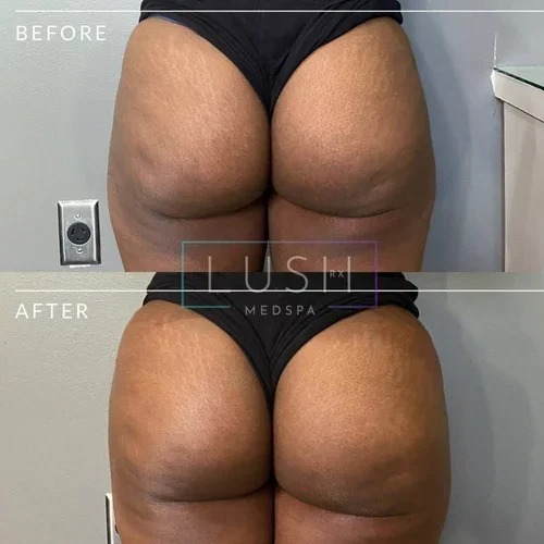 Sculptra BBL Before and After