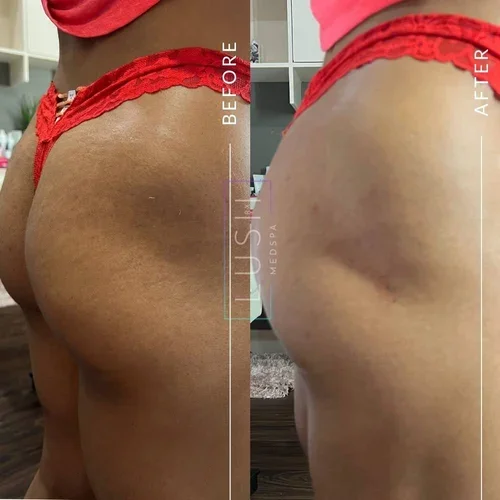 Sculptra BBL Before and After