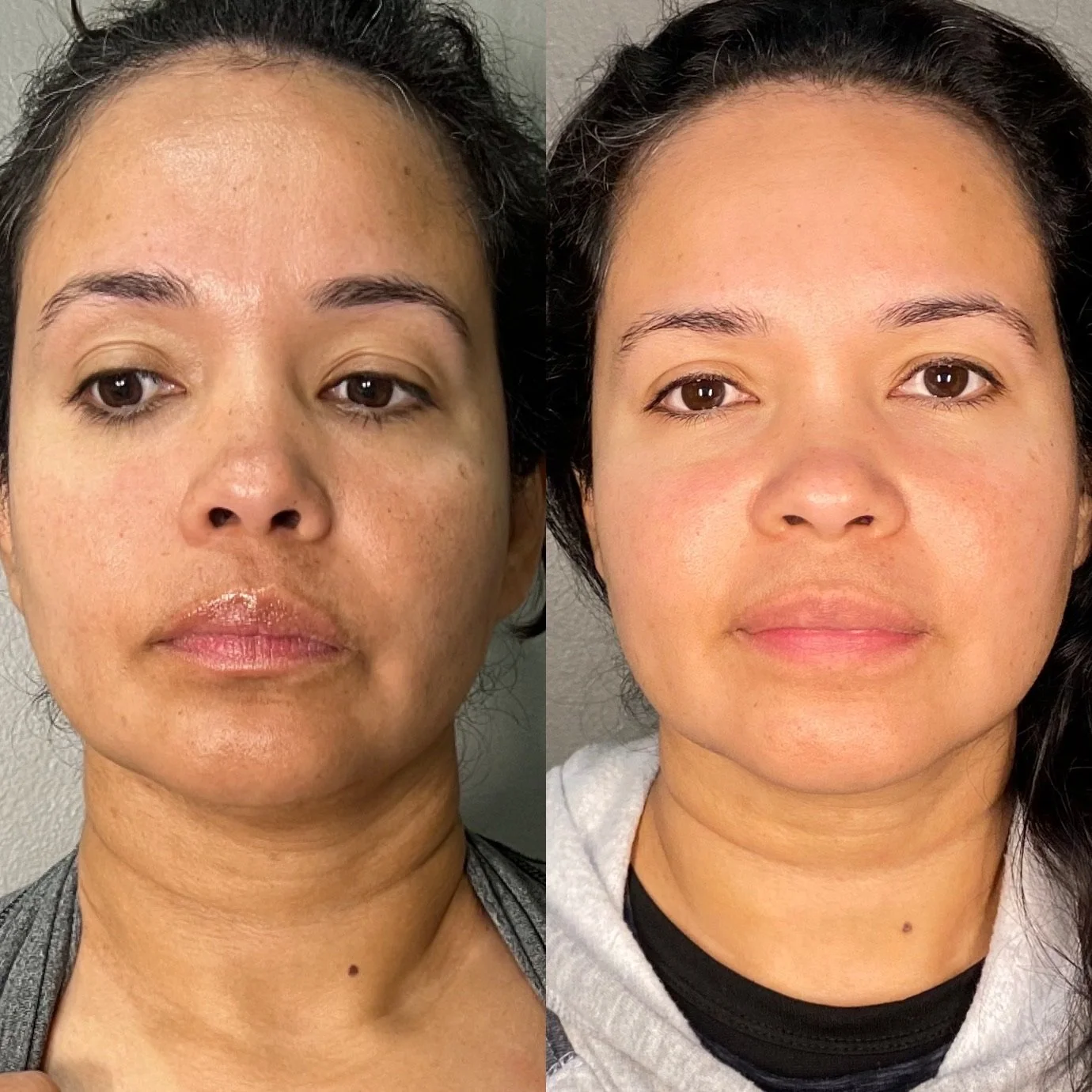 Microneedling Before and After, Houston, TX, at Lush RX in Bellaire