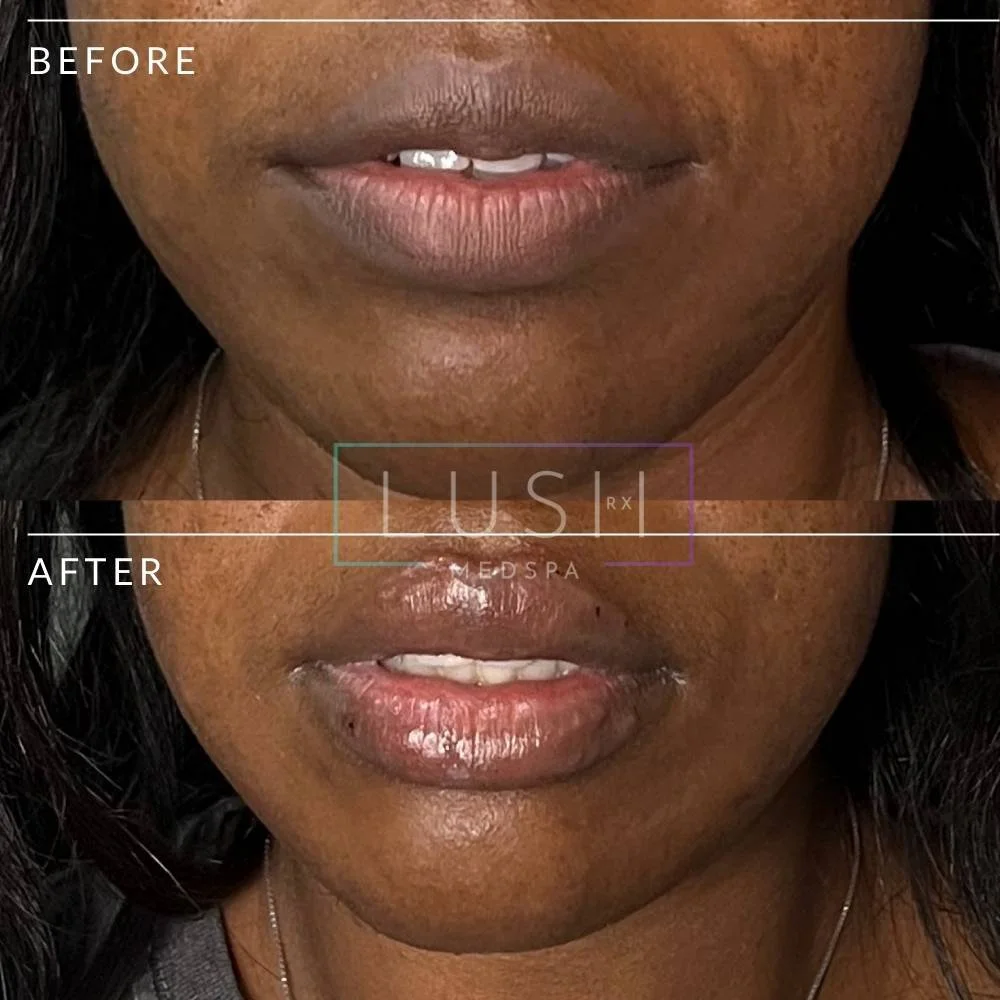 Fullips Before And After