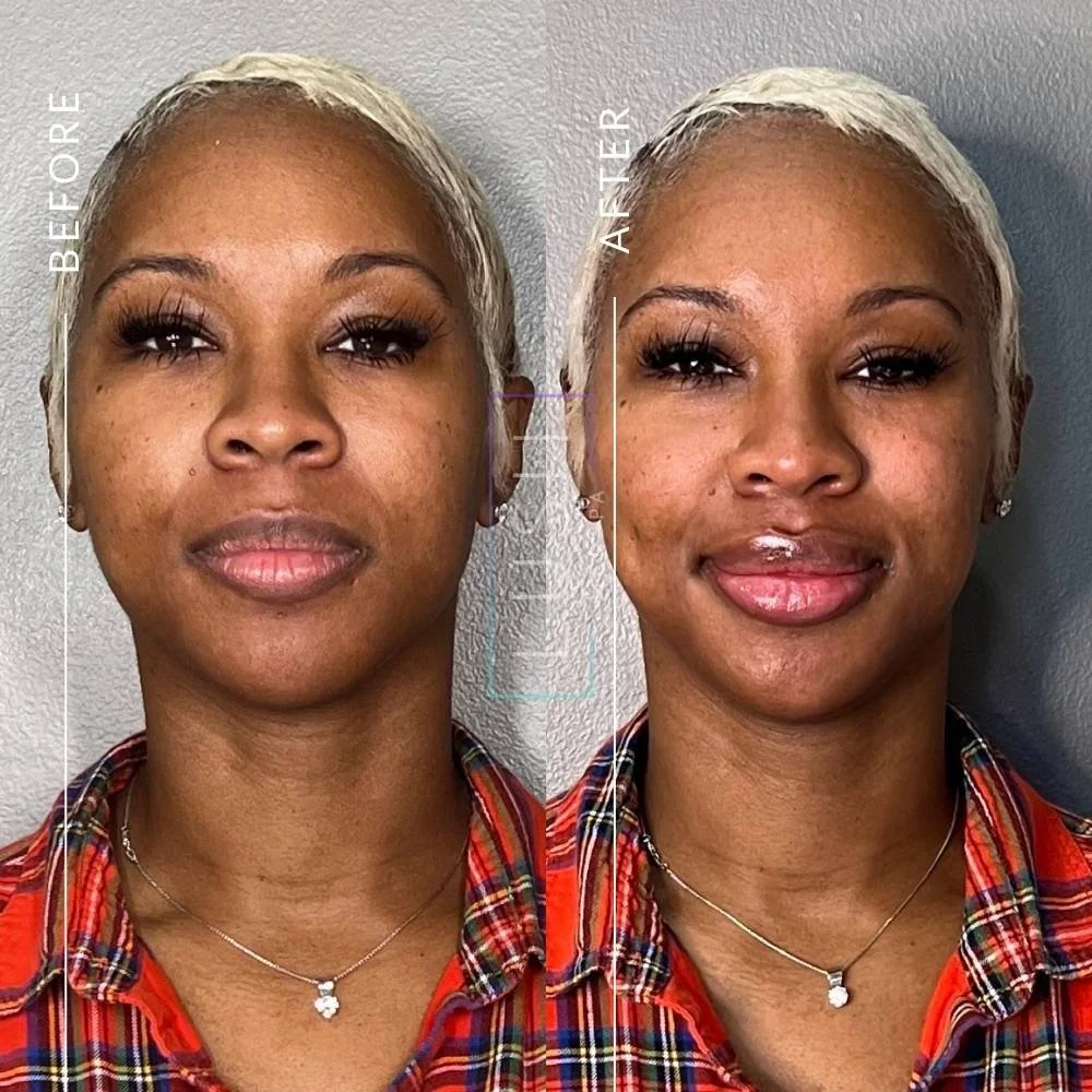 PDO Threads NonSurgical Facelift Houston, TX Lush RX Med Spa