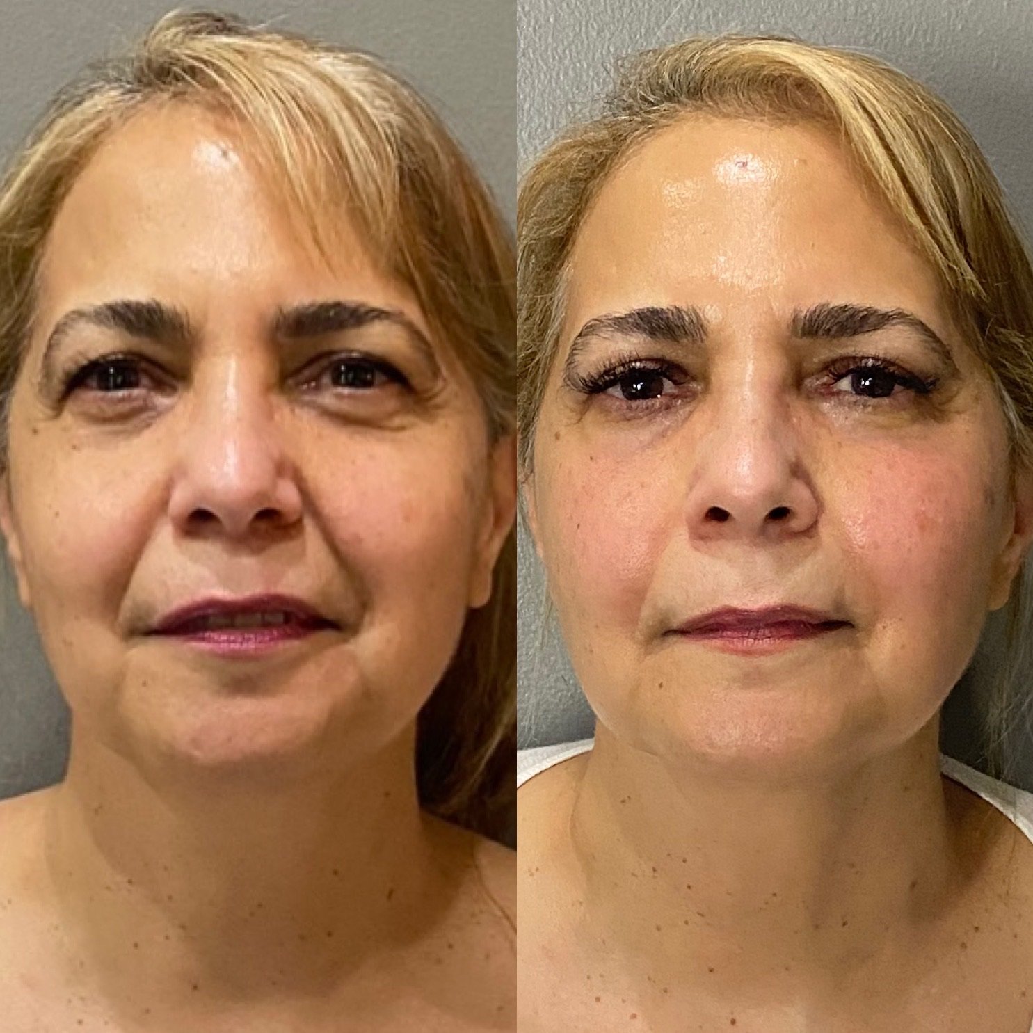 Laser Treatment Before and After in Houston, TX, at LushRX.