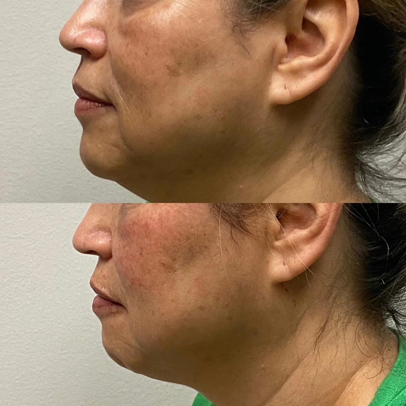 Laser Treatment Before and After in Houston, TX, at LushRX.