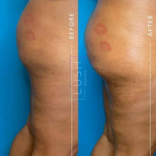 Non-Surgical Butt Lift Before and After