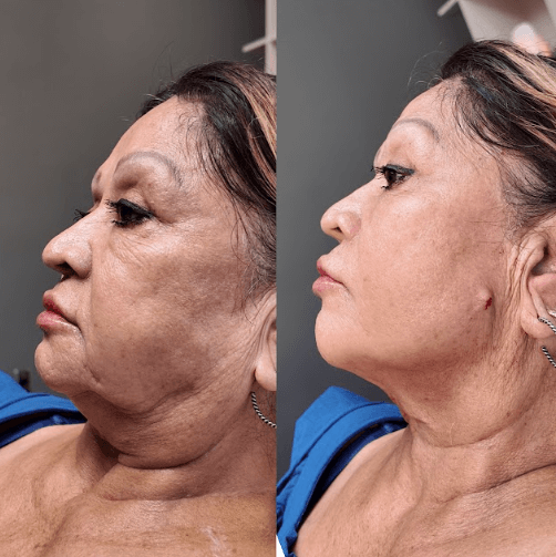 Compressed_before-and-after-pdo-threads-treatment-houston-tx_LushRX (2).png