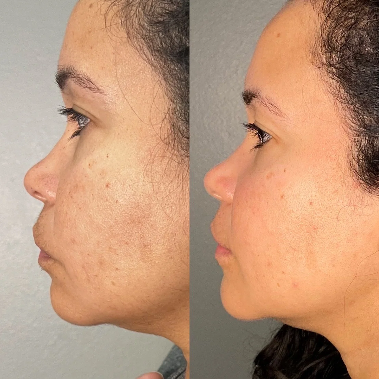 Microneedling Before and After, Houston, TX, at Lush RX in Bellaire