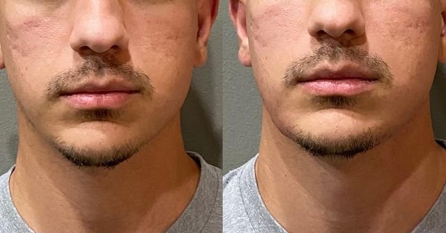 Sculpting the male jawline: Chin and neck contouring 101