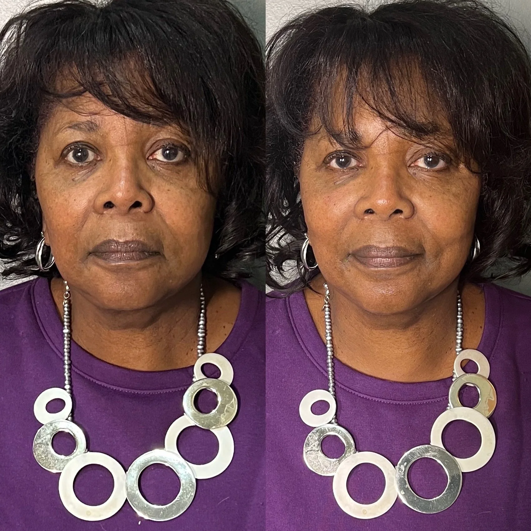 Laser Treatment Before and After in Houston, TX, at LushRX.