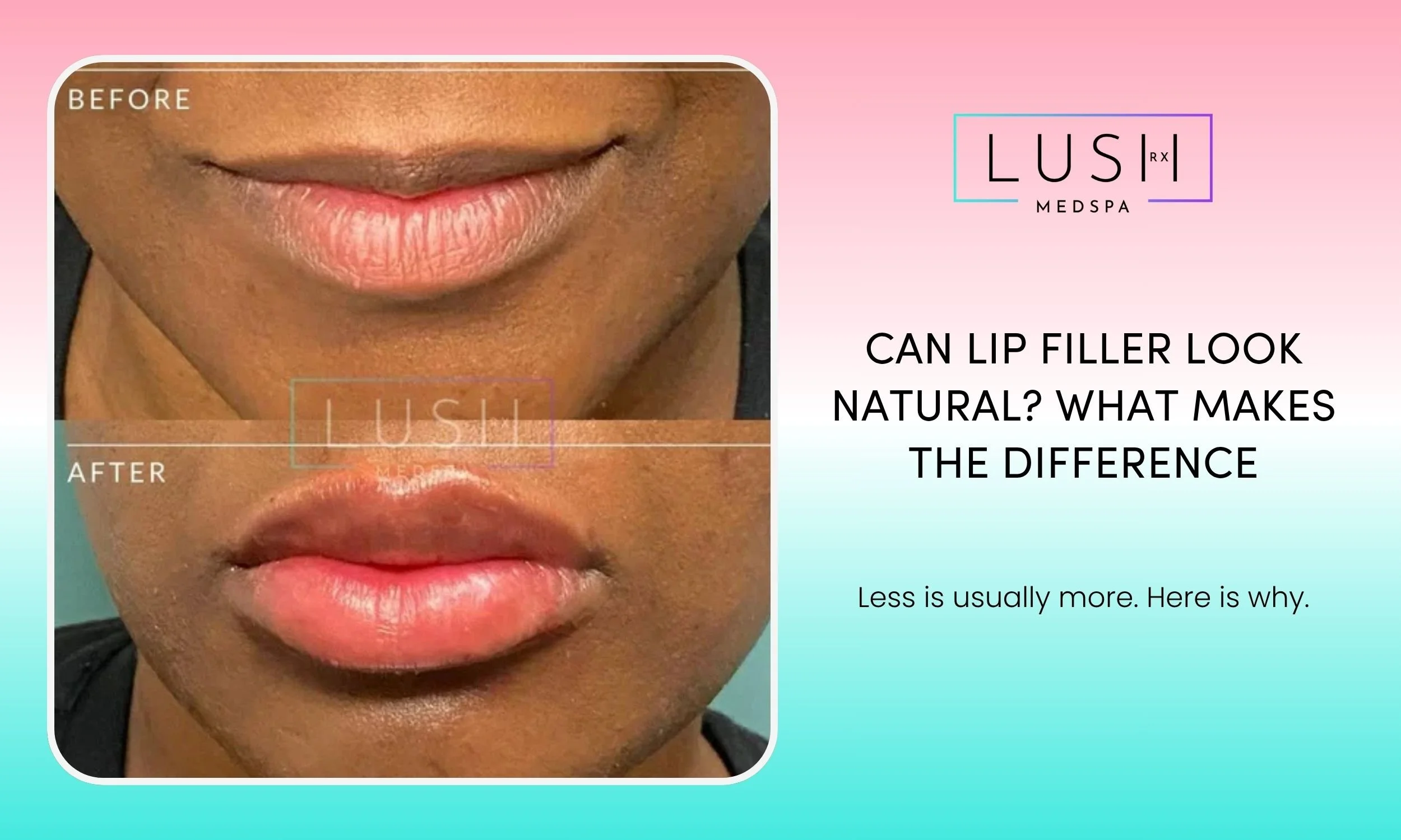 Natural lip filler look