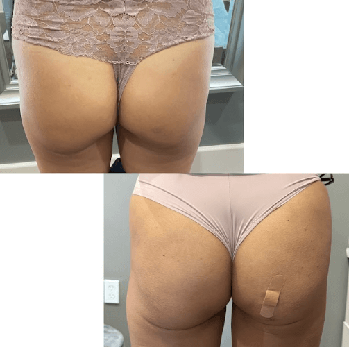 Compressed_before-and-after-non-surgical-bbl-treatment-houston-tx_LushRX.png