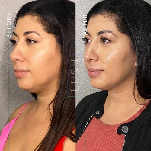 Facial filler before and after results