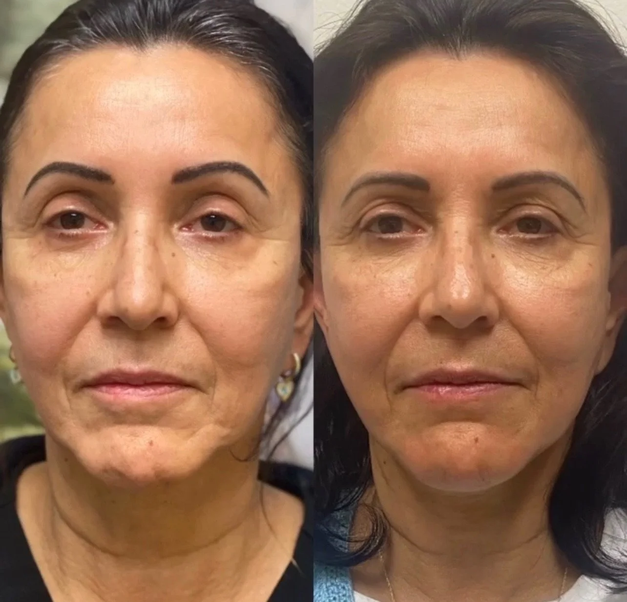 Laser Treatment Before and After in Houston, TX, at LushRX.