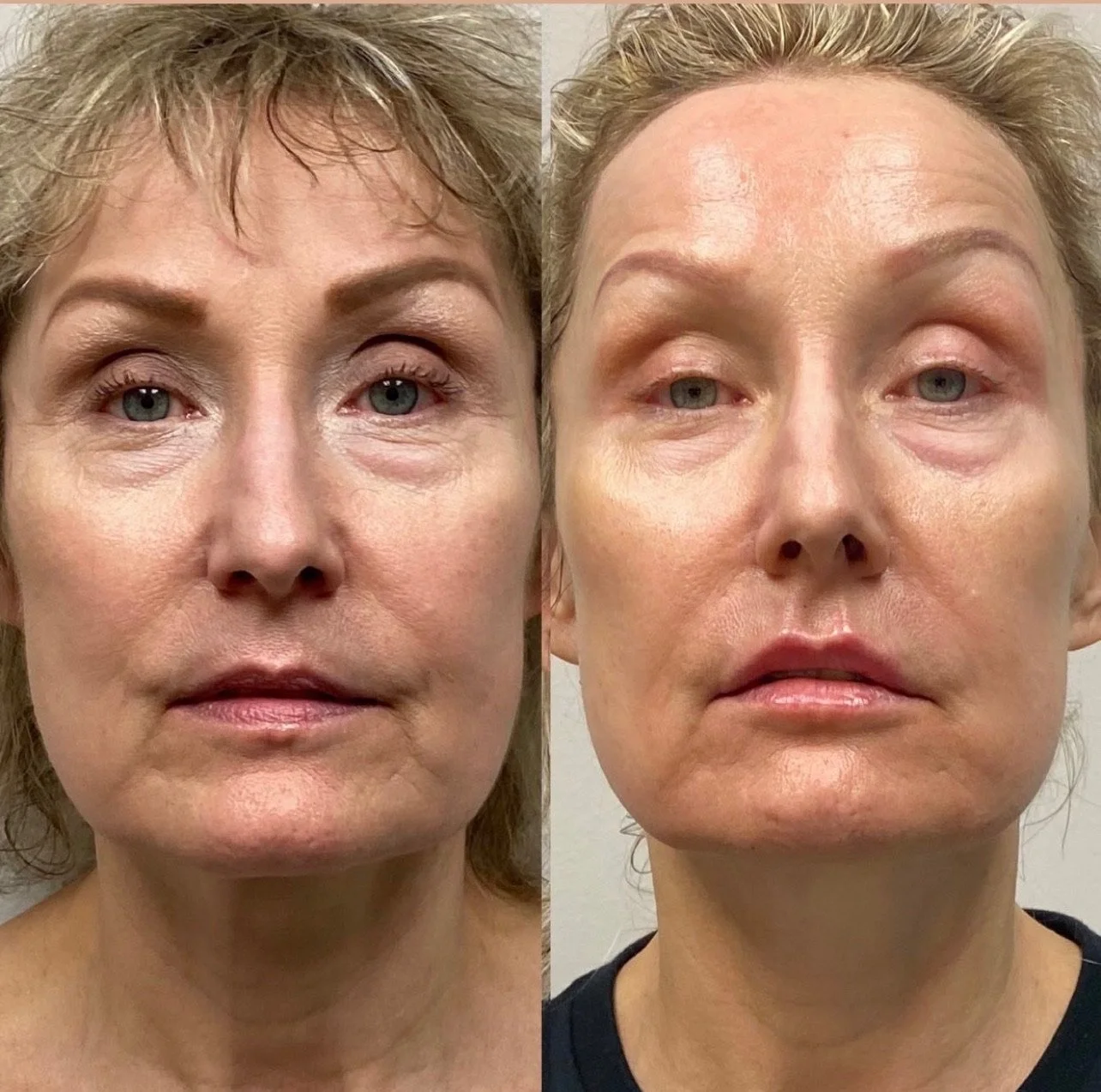 Laser Treatment Before and After in Houston, TX, at LushRX.