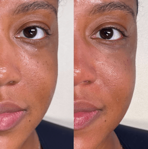 Compressed_before-and-after-tear-trough-treatment-houston-tx_LushRX (2).png