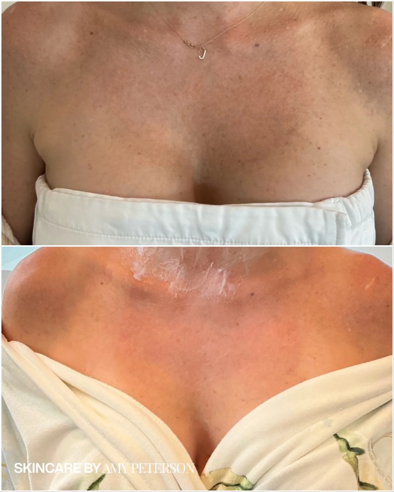 The results speak for themselves. ✨

BBL HEROic isn&rsquo;t just for the face&mdash;it&rsquo;s one of the most effective ways to fade sun spots and reverse summer damage on the body.

As seen here on the chest, this light-based treatment restores cla