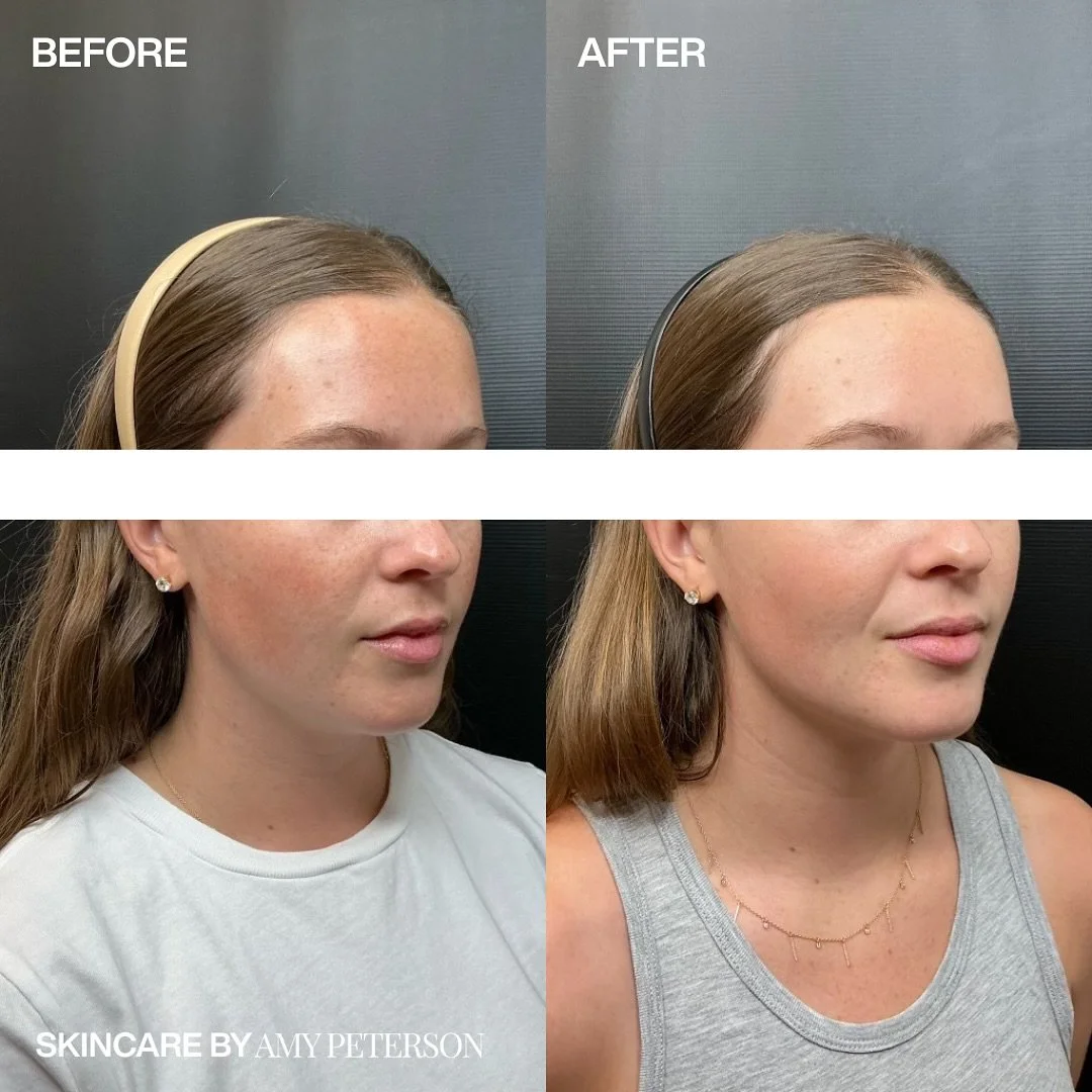 Why stop glowing at checkout? ✨

This patient had Clear + Brilliant and Aerolase in-office and took the results even further with @lenoxandsixteenth The Laser Serum at home.

It&rsquo;s like having a little laser in your bathroom cabinet, keeping tha