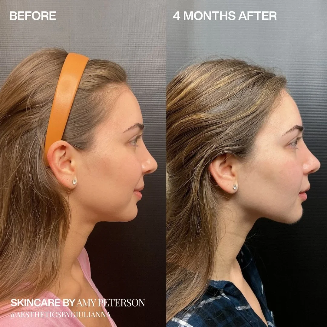 Redefining the lower face.

Masseter Botox softens and slims. The Nefertiti Lift restores definition along the jaw and neck. Together they create a more elongated and elegant profile while keeping your expression completely natural.

✨ Masseter Botox