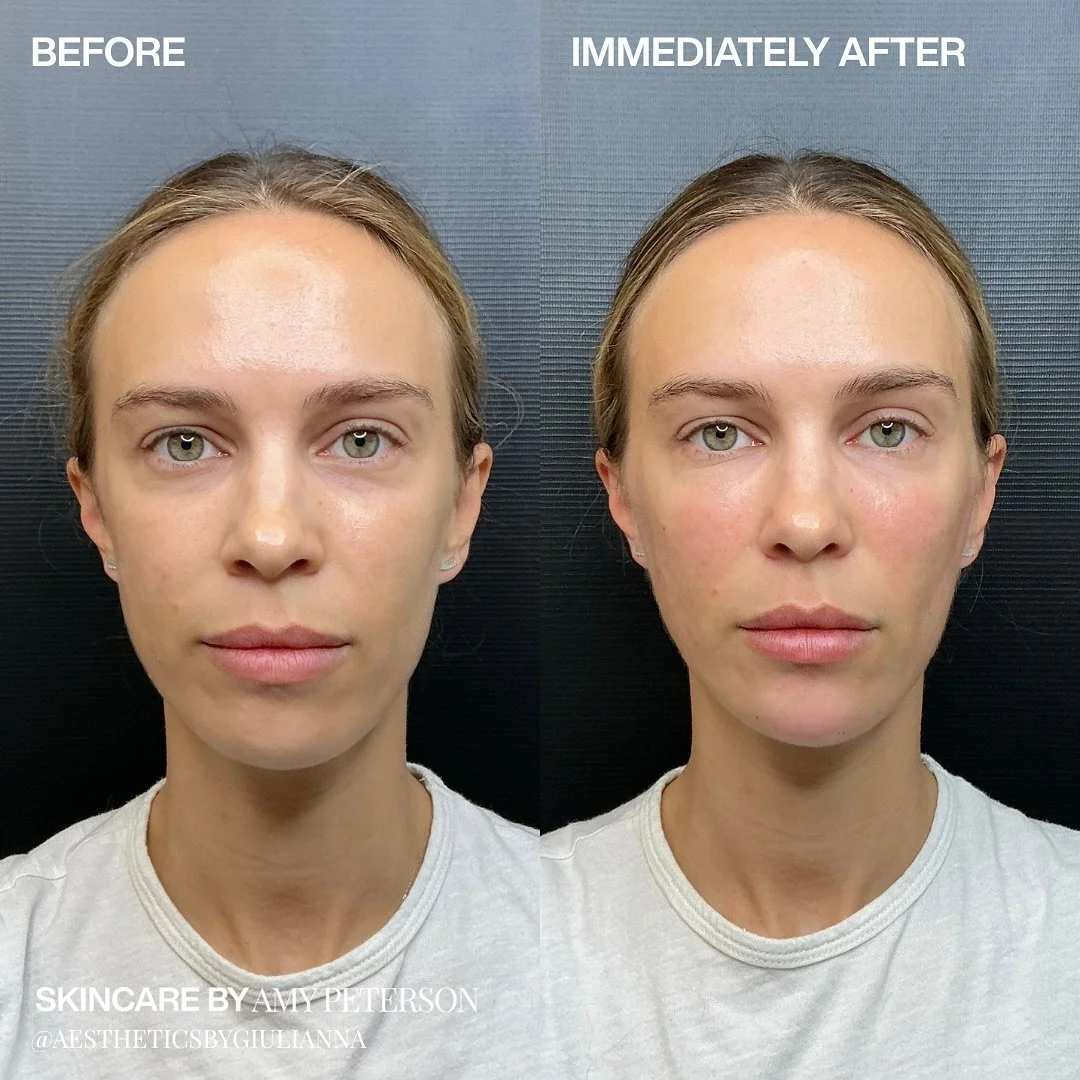The undetectable injectable. ✨

Our philosophy has always been rooted in balance &mdash; never overdone, always refined. With this client&rsquo;s treatment, we restored subtle volume and softness exactly where it was needed, for results that look and