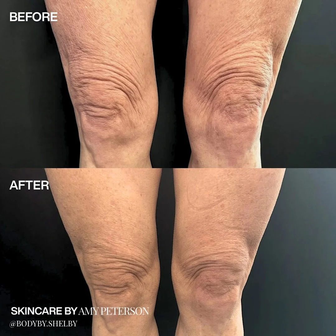 A little lift goes a long way.

This treatment targets skin laxity, and this time we used it on the knees.

 Comment &ldquo;knees&rdquo; below to find out which treatment this is 👇