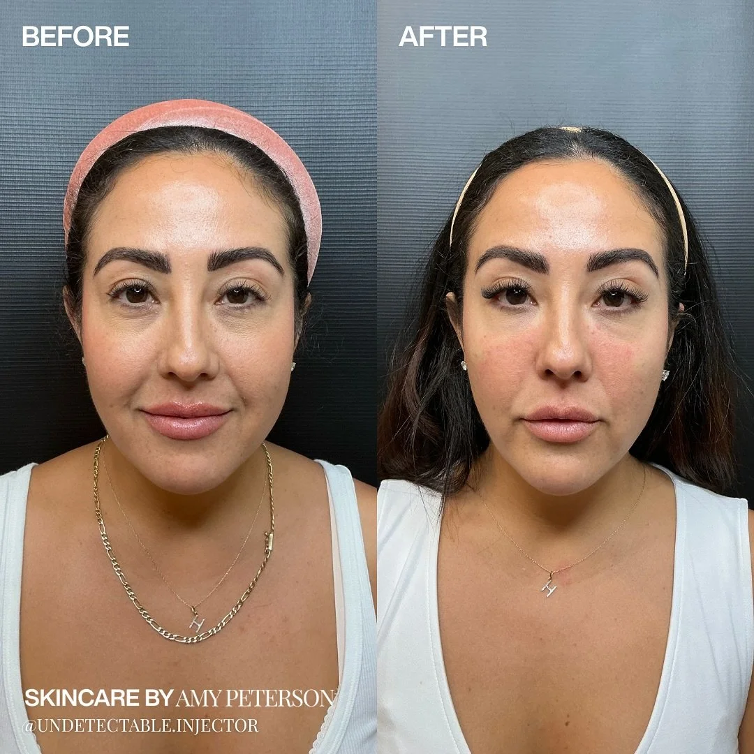 ✨A transformation that goes far beyond aesthetics ✨

This beautiful patient came in feeling like her face didn&rsquo;t reflect the energy and confidence she felt inside. She worried she&rsquo;d never achieve the balance and harmony she wanted but wit