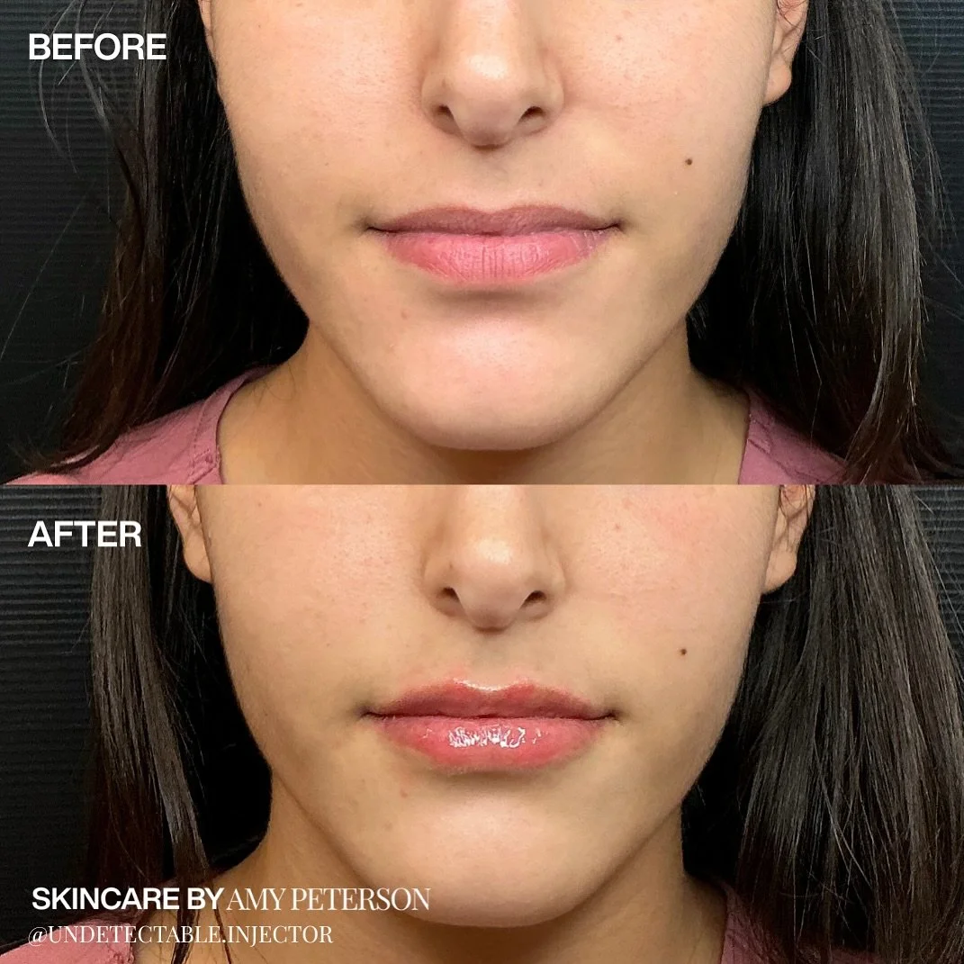 A little volume, a lot of intention. 

This treatment focuses on defining the borders, restoring hydration, and rebalancing proportions for a naturally fuller look. 

The goal: lips that move, feel, and age beautifully.