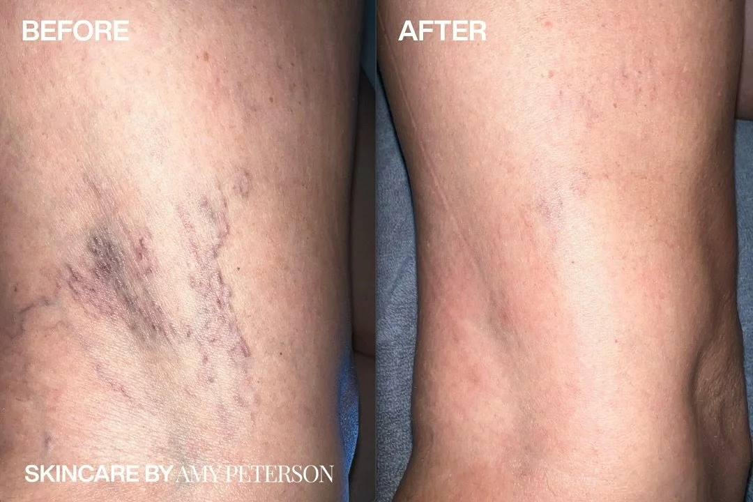 A closer look at what sclerotherapy can do.
This treatment targets small veins, gently fading them for a more refined, even tone.

Get your best legs in time for Art Basel season.

Call or click the link in bio to book your consult today.
