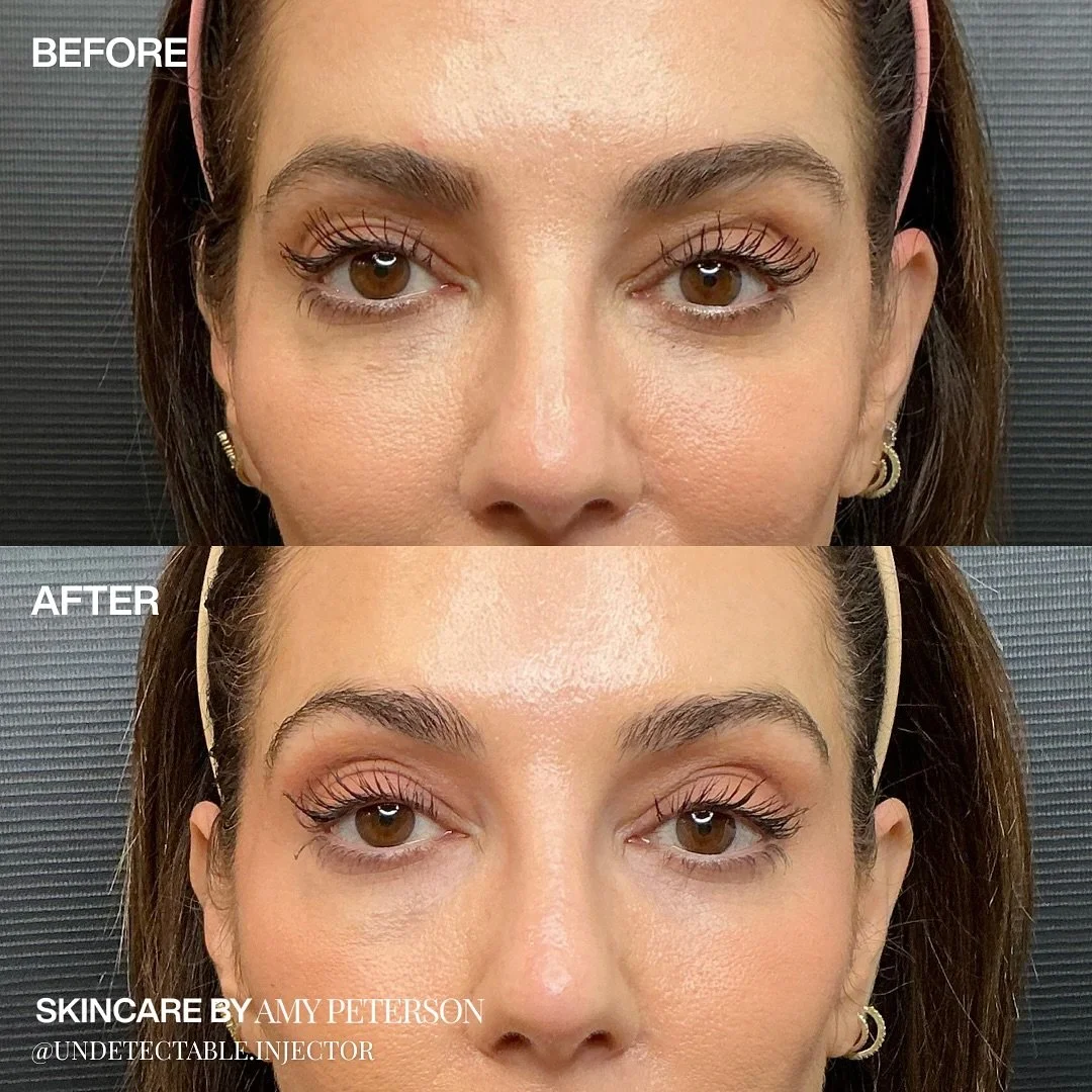 A refreshed gaze without changing your expression.

Our under eye treatments focus on subtle rejuvenation, brightening, smoothing, and restoring balance while keeping your natural look intact.

✨ Comment &ldquo;under eyes&rdquo; to learn more about o