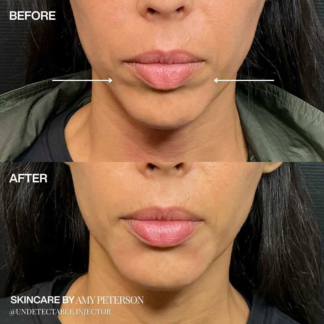 Chin shadows can subtly change how light hits the face, creating the illusion of heaviness or imbalance. With precise Renuva placement, we restore smooth contours and natural harmony.
⁣
A small adjustment, a big difference.