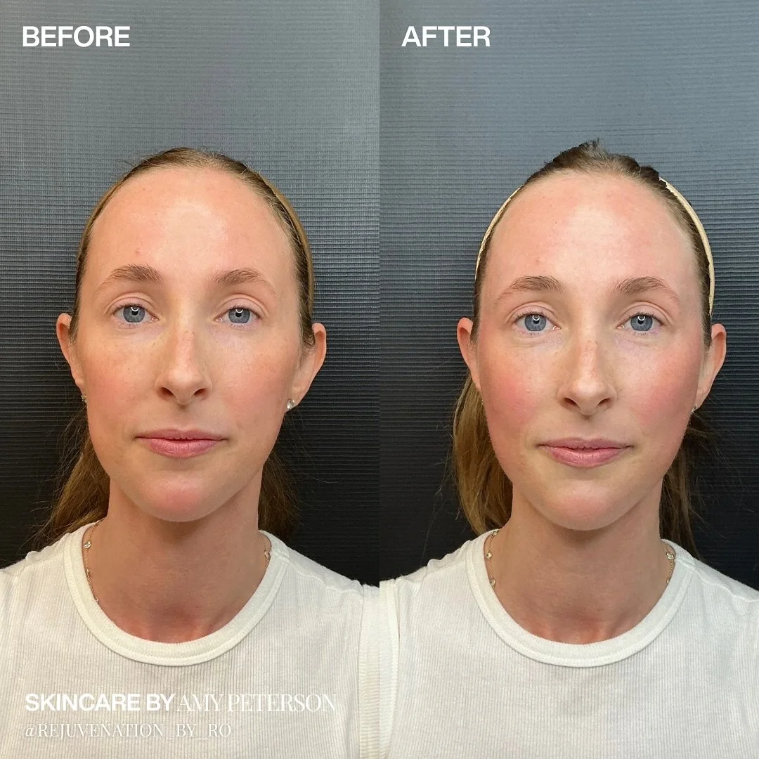 Temples turn back time. ✨

This Renuva transformation subtly restores volume to the temples and pre-auricular area, creating a softer, more youthful contour. By stimulating your own fat regeneration, Renuva refines facial harmony from within... no fi