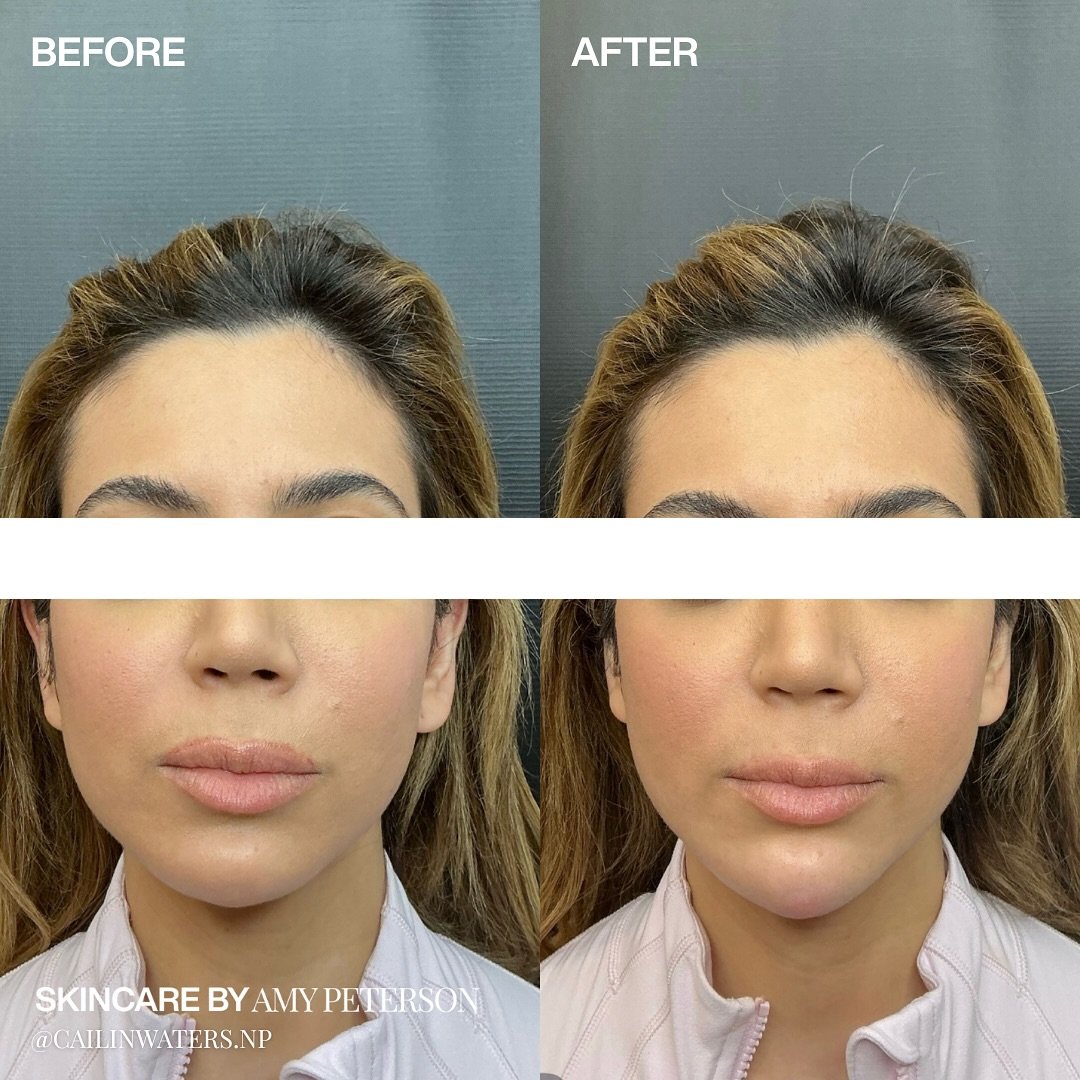 Subtle changes, refined results. ✨

A touch of filler to the chin can bring harmony and balance to your facial features, enhancing your profile without changing your essence.

Comment &ldquo;chin&rdquo; to learn more about our approach to facial bala