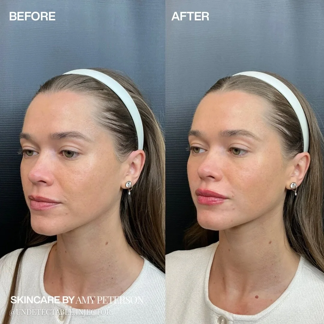 Subtle, balanced, and beautifully hers. 

This client came in wanting to enhance lip symmetry without adding noticeable volume. Just a touch of filler was all it took to refine her shape and create the perfect, natural pout.

Proof that sometimes, le