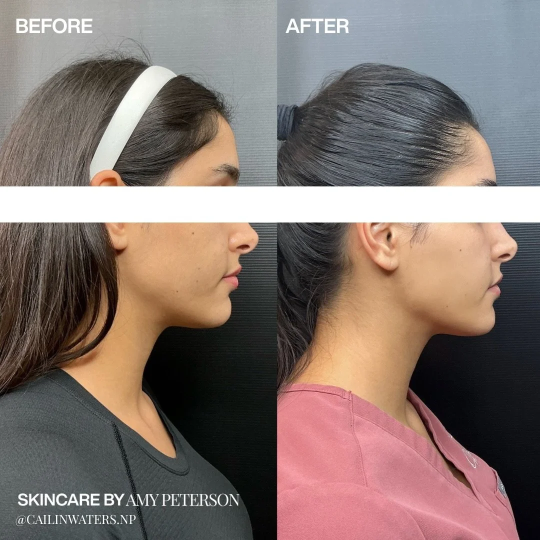 This patient combined masseter and Nefertiti Botox to soften the jawline and elongate the neck, creating a more lifted, elegant profile without adding volume.

Book your consult today!