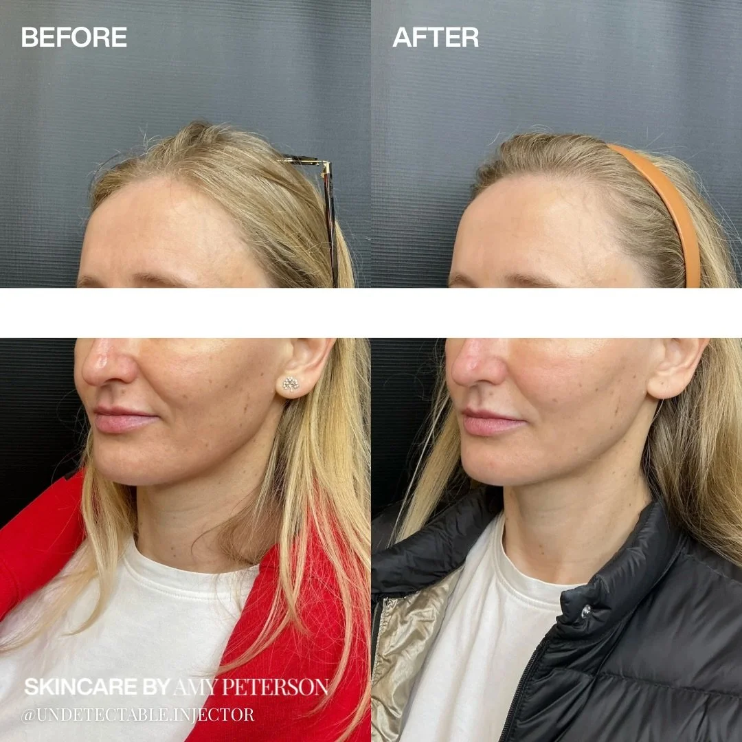 Renuva to the midface and preauricular
area, paired with botox for a lifted, more
youthful contour.

This combination restores subtle volume and smooths dynamic lines for a retreshed, natural result.