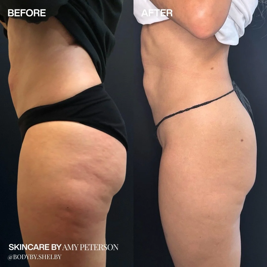 The art of body contouring meets science-backed precision.

Our customized treatment plans target texture, tone, and shape for results that feel effortless.

Swipe to see our favorite body products to pair with treatments! Shop the Black Friday Sale 