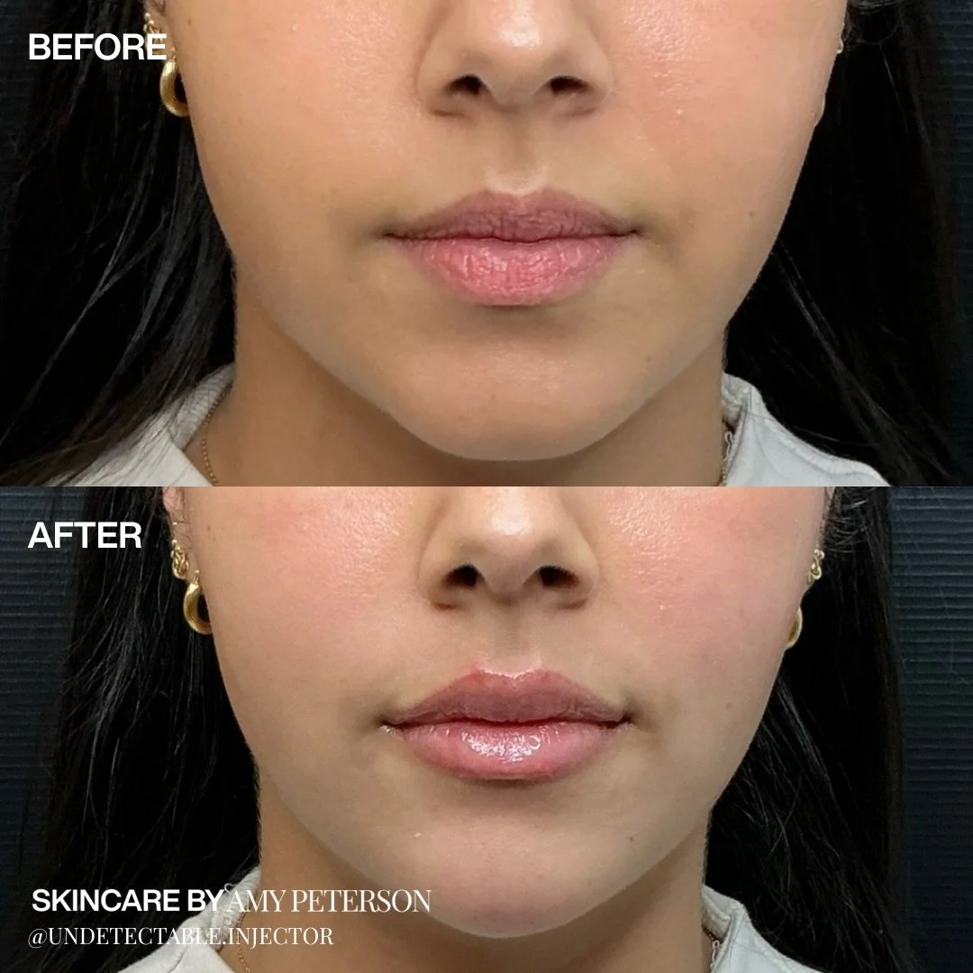 Soft, balanced, and perfectly yours.

A subtle touch of filler can refine shape, restore harmony, and enhance what you already have.

Swipe to discover the products we love for keeping lips smooth, hydrated, and gloss-ready during our sale.