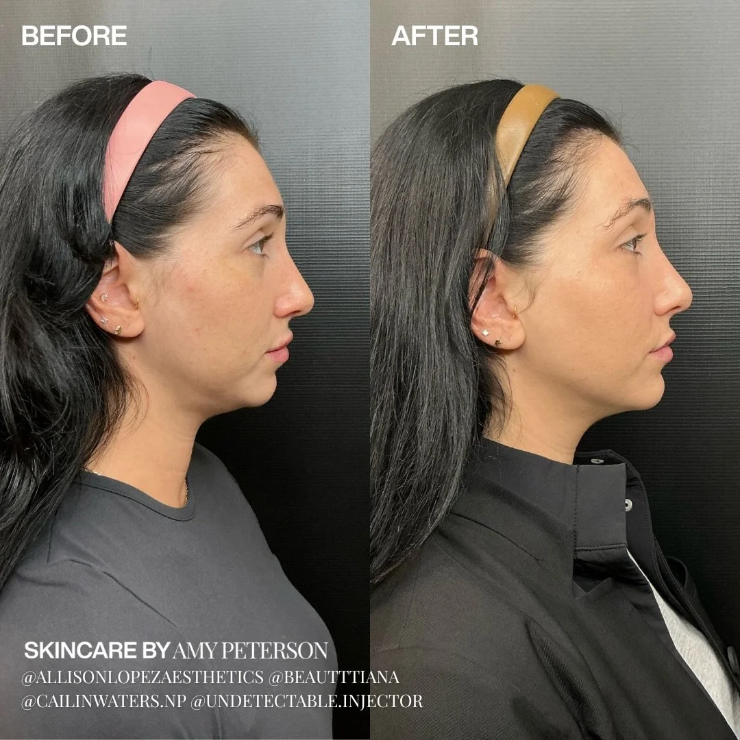 When expertise comes together, the results speak softly but beautifully.

Endolift for lift and contour, chin filler for subtle balance.