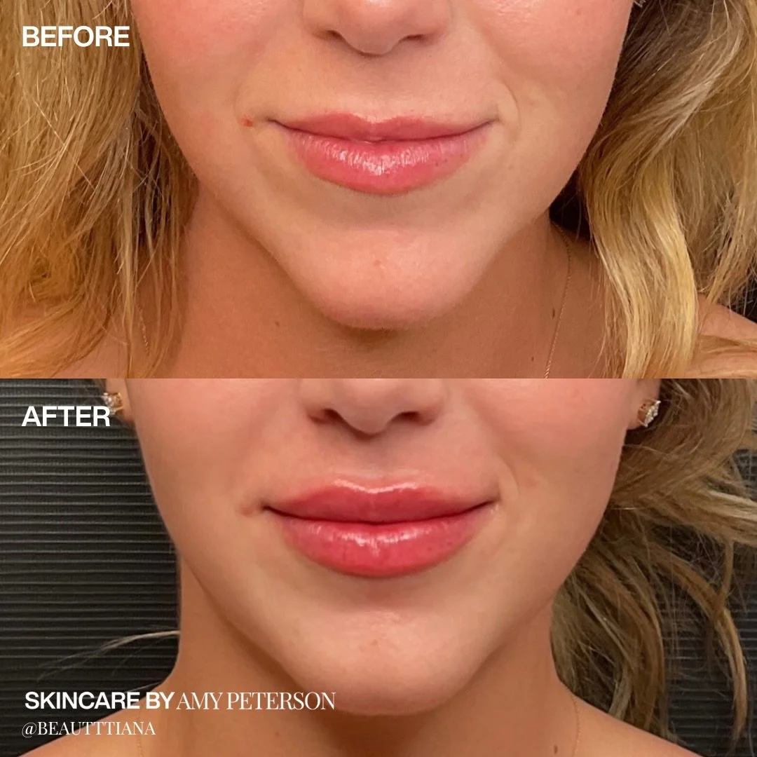 Mistletoe or the midnight kiss &mdash; either way, let your lips do the talking&hellip; 

Lip filler is one of our favorite ways to enhance shape, restore hydration, and create soft, balanced volume that still looks like you.

Just in time for the ho