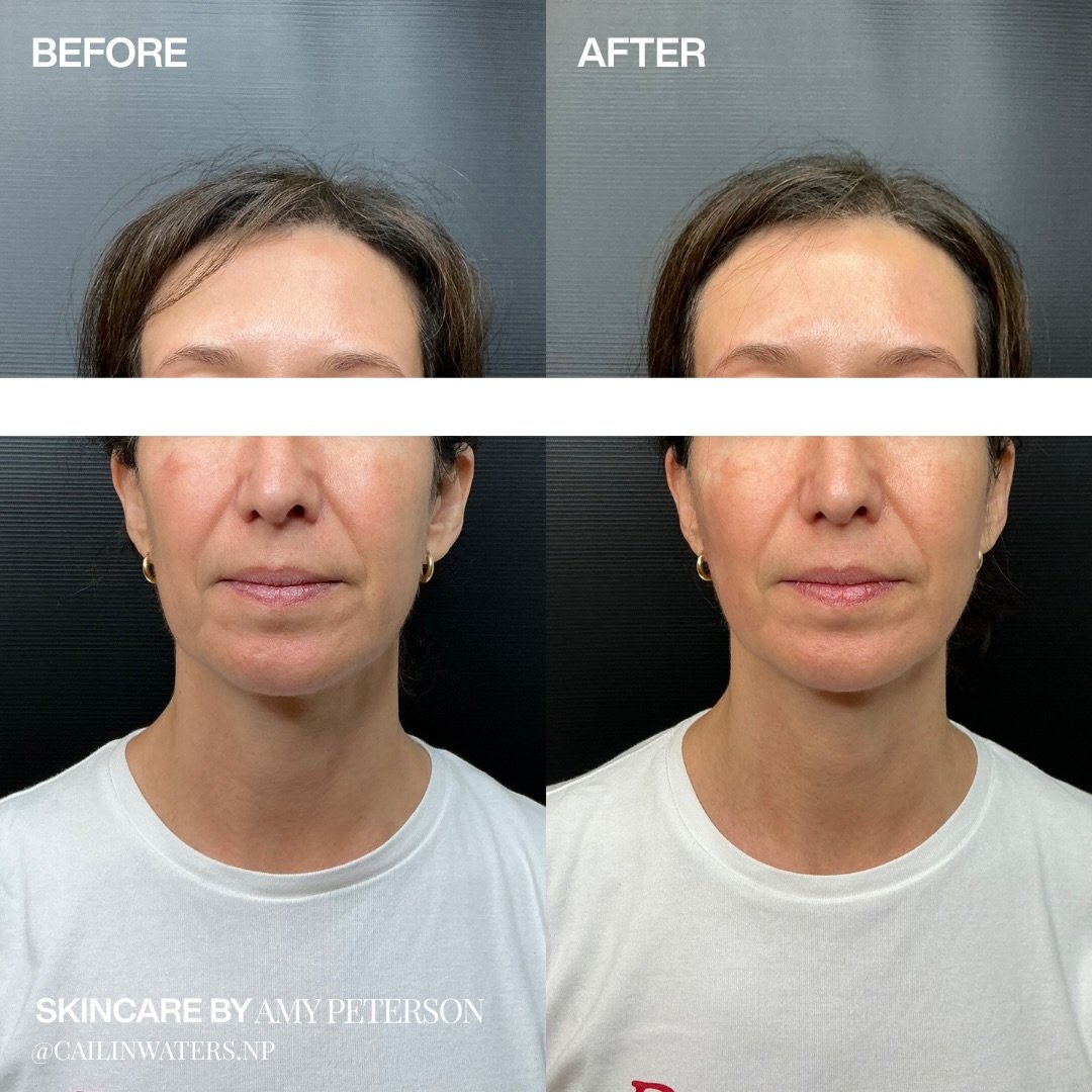 Quiet support, placed with intention.

Renuva in the preauricular area to subtly anchor the face where lift truly begins. 

This isn&rsquo;t about adding volume it&rsquo;s about restoring structure, improving balance, and creating that barely-there p